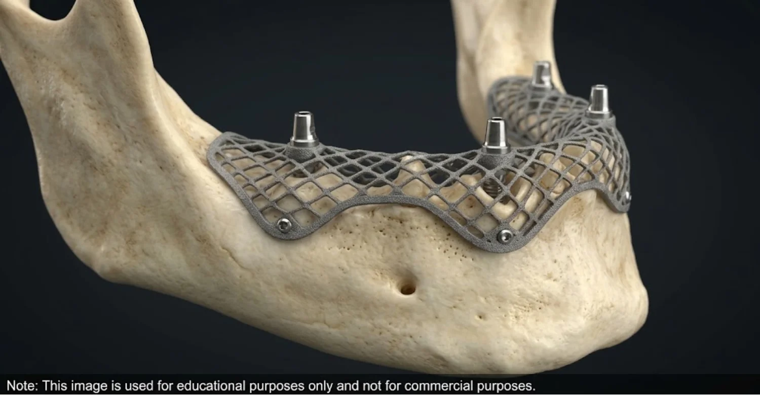 Hybrid Subperiosteal Implant Rehabilitation 2